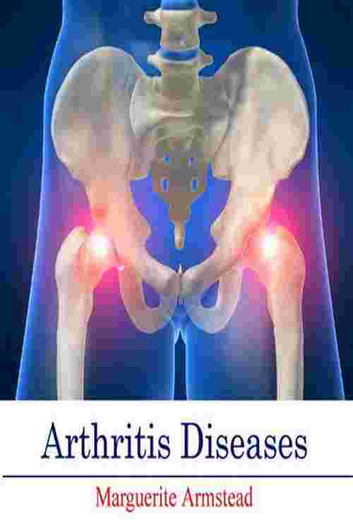 Arthritis Diseases