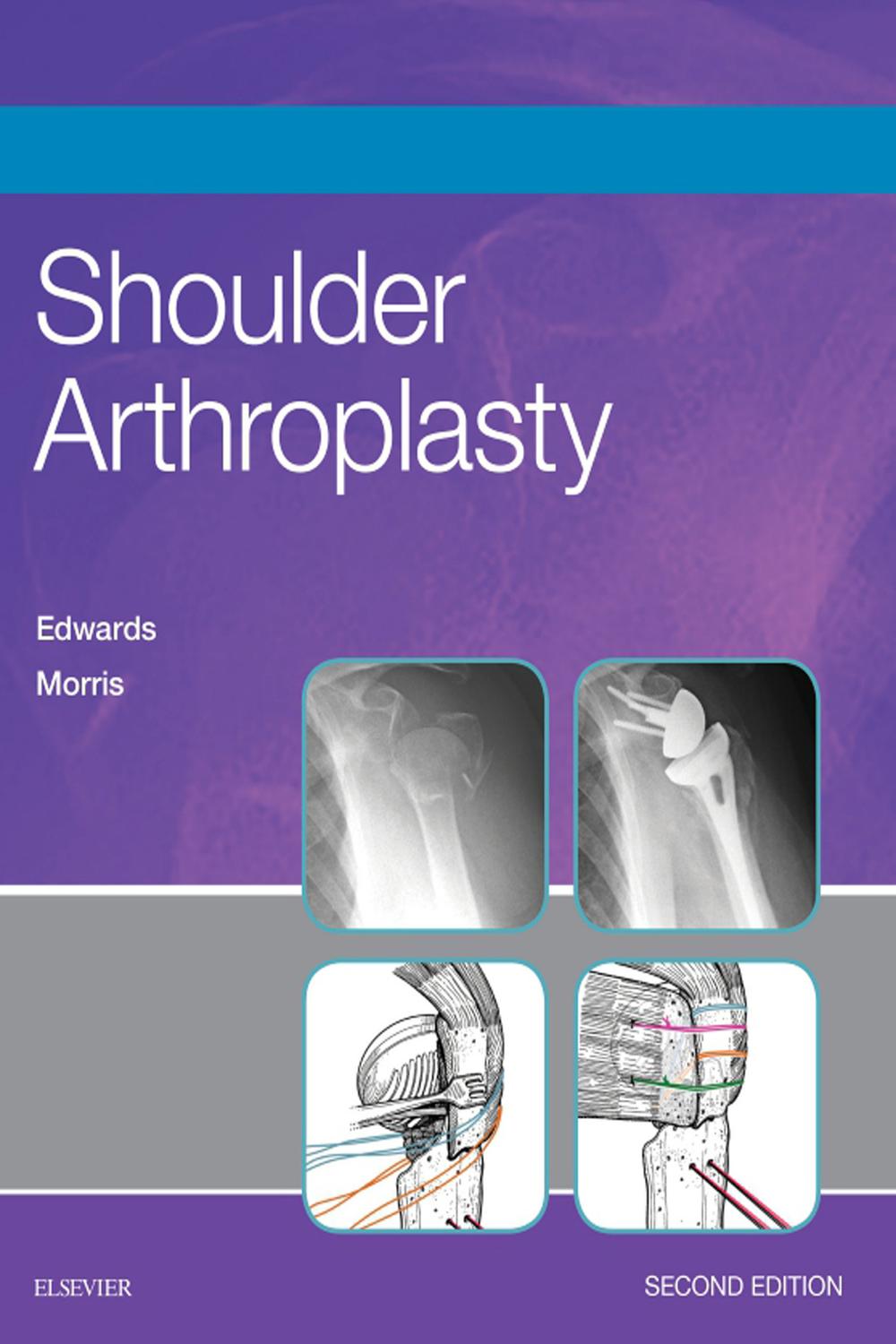 Shoulder Arthroplasty E-Book - T. Bradley Edwards, Brent J. Morris