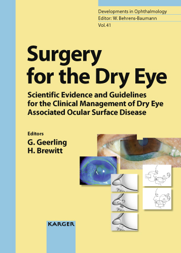Surgery for the Dry Eye - Bandello, Geerling, Brewitt