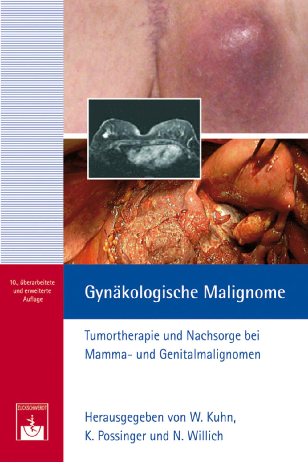 Gynäkologische Malignome - Walther Kuhn, Kurt Possinger, Willich Normann