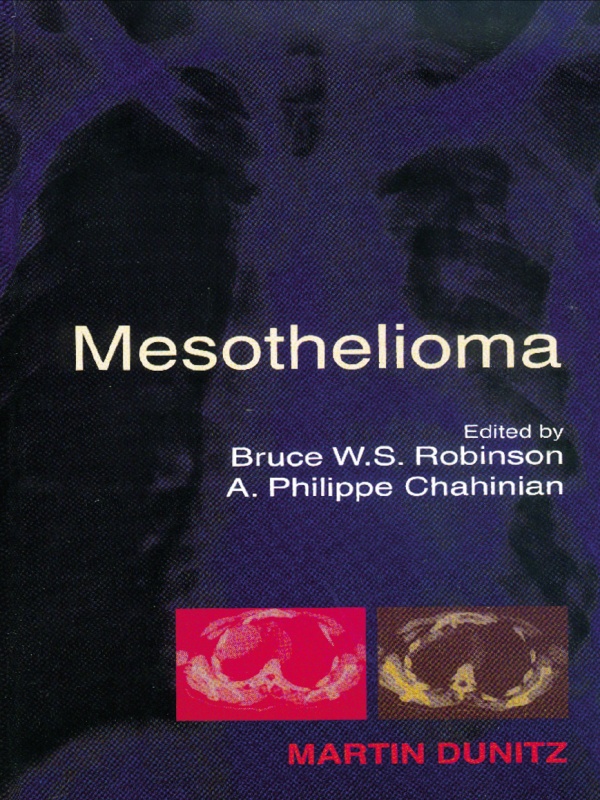Mesothelioma - Bruce W S Robinson, A Philippe Chahinian