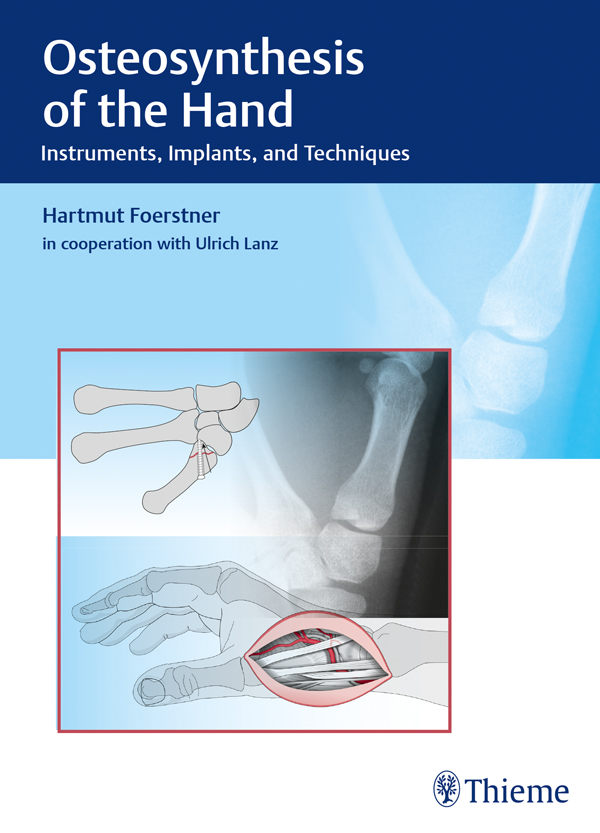 Osteosynthesis of the Hand - Hartmut Forstner